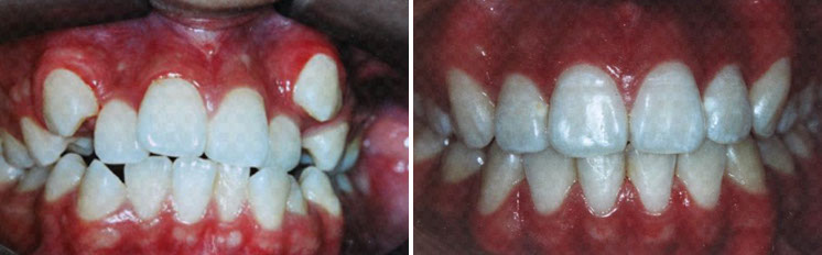 affrodable porcelain crowns